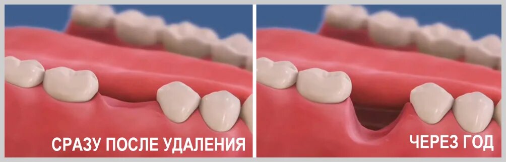 Имплантация зуба сразу после его удаления