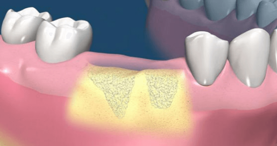 Восстановление костной ткани зубов. Пластика костной ткани при имплантации зубов. Остеопластика костной ткани. Костная пластика (наращивание кости). Имплантация зубов костная ткань ткань.
